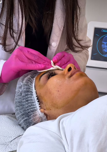 BioFiller + Microneedling